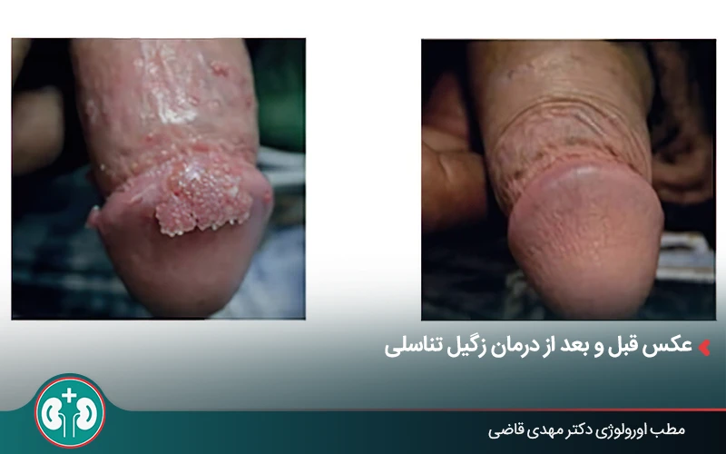 مقارنة بالصورة قبل وبعد علاج الثآليل التناسلية في المنطقة التناسلية لدى الرجال