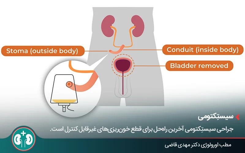 تصویر گرافیکی که حذف مثانه و جمع شدن ادرار در کیسه را نشان میدهد