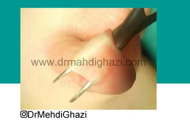 بریج آلت یا چسبندگی آلت