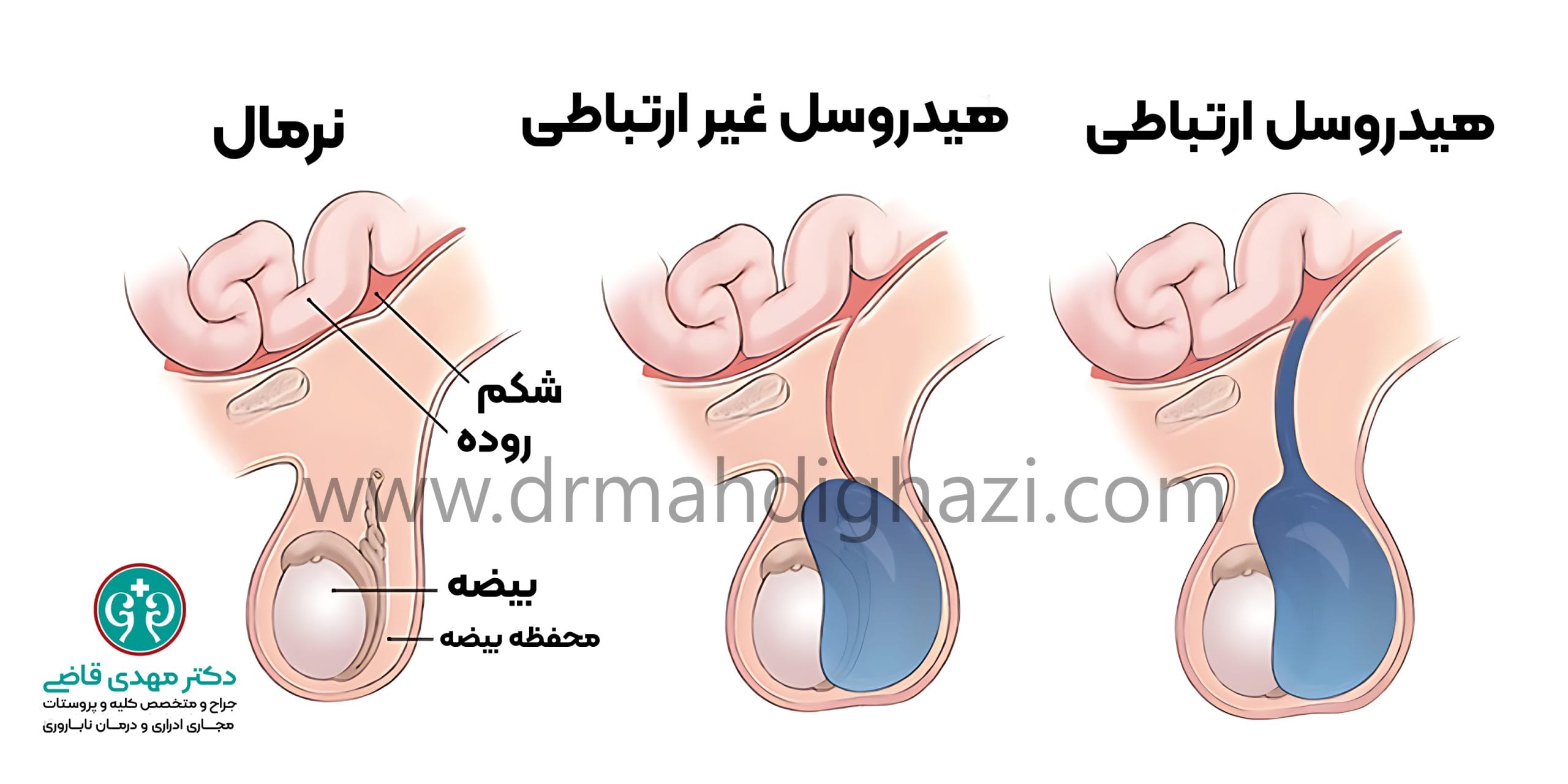 دکتر قاضی-هیدروسل: بررسی انواع، علل، تشخیص و روشهای درمان