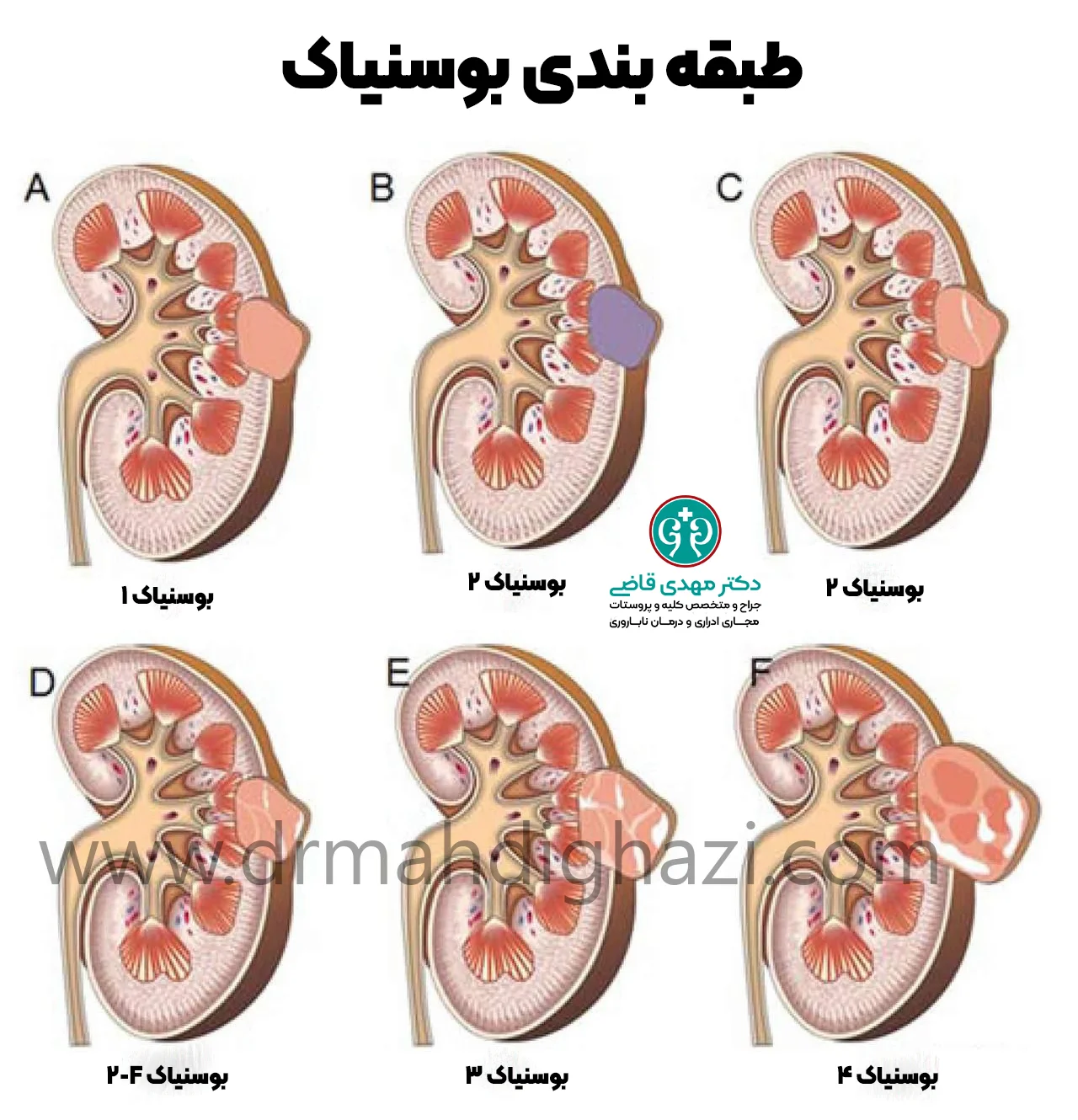 دکتر قاضی- کیستهای کلیوی
