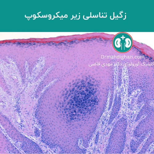 صورة مجهرية ضوئية للورم الحليمي الناجم عن فيروس الورم الحليمي البشري (HPV) حيث تحتوي الطبقة الحبيبية على كميات كبيرة من حبيبات الكيراتوهيالين (فرط التحبب). كما تظهر الأدمة (الطبقة
