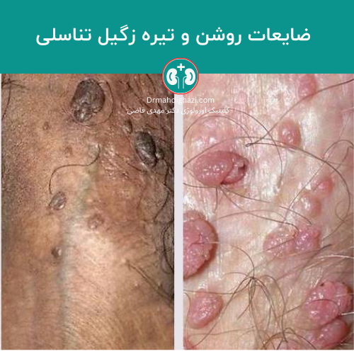 صورة للثآليل التناسلية الفاتحة والداكنة في منطقة الأعضاء التناسلية الذكرية