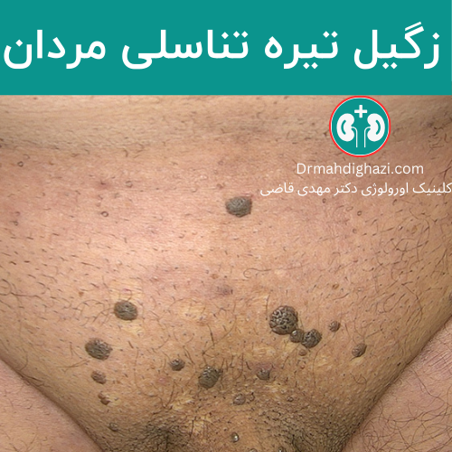 صورة لعدد من الثآليل الداكنة والكبيرة في منطقة الأعضاء التناسلية لدى الذكور