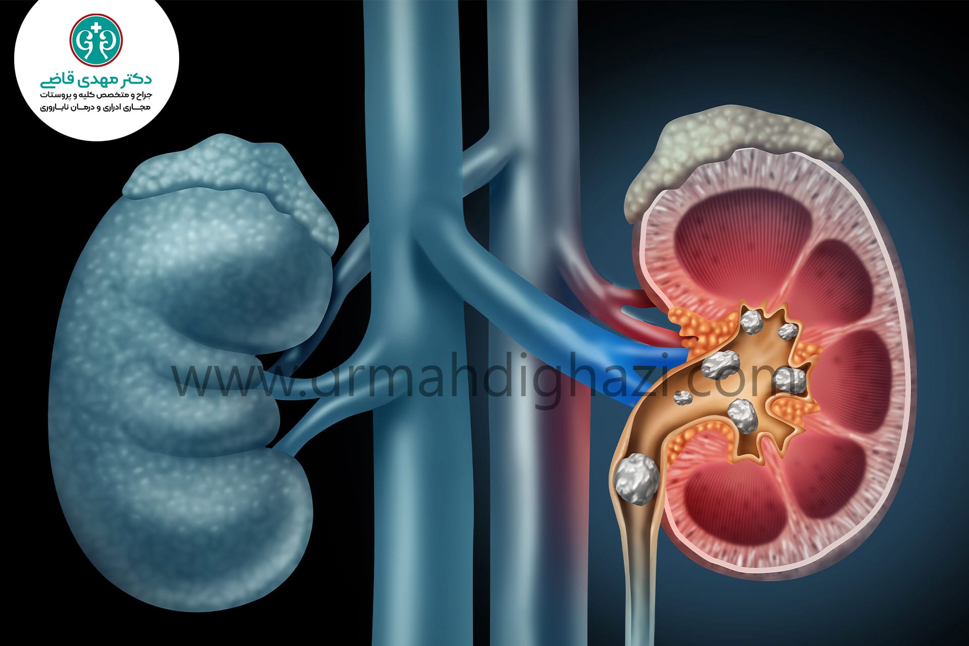 دکتر مهدی قاضی-سنگ کلیه سنگ حالب سنگ ادراری سنگ سیستم ادراری نفرولیتیازیس علل سنگ کلیه درمان سنگ کلیه پیشگیری از سنگ کلیه عوارض سنگ کلیه تشخیص سنگ کلیه جراحی سنگ کلیه سنگ کلیه در بارداری رژیم غذایی برای سنگ کلیه روش‌های درمان سنگ کلیه بدون جراحی علائم اولیه سنگ کلیه چیست؟ چگونه از تشکیل سنگ کلیه جلوگیری کنیم؟ مواد غذایی مفید برای بیماران سنگ کلیه بهترین نوشیدنی‌ها برای دفع سنگ کلیه تأثیر مصرف آب بر کاهش سنگ کلیه داروهای موثر برای درمان سنگ کلیه علل رایج تشکیل سنگ کلیه در مردان و زنان