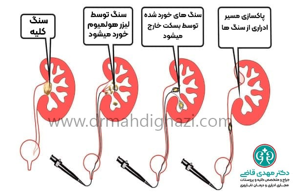 دکتر مهدی قاضی-سنگ کلیه سنگ حالب سنگ ادراری سنگ سیستم ادراری نفرولیتیازیس علل سنگ کلیه درمان سنگ کلیه پیشگیری از سنگ کلیه عوارض سنگ کلیه تشخیص سنگ کلیه جراحی سنگ کلیه سنگ کلیه در بارداری رژیم غذایی برای سنگ کلیه روش‌های درمان سنگ کلیه بدون جراحی علائم اولیه سنگ کلیه چیست؟ چگونه از تشکیل سنگ کلیه جلوگیری کنیم؟ مواد غذایی مفید برای بیماران سنگ کلیه بهترین نوشیدنی‌ها برای دفع سنگ کلیه تأثیر مصرف آب بر کاهش سنگ کلیه داروهای موثر برای درمان سنگ کلیه علل رایج تشکیل سنگ کلیه در مردان و زنان