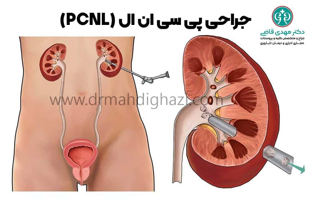 دکتر مهدی قاضی-سنگ کلیه سنگ حالب سنگ ادراری سنگ سیستم ادراری نفرولیتیازیس علل سنگ کلیه درمان سنگ کلیه پیشگیری از سنگ کلیه عوارض سنگ کلیه تشخیص سنگ کلیه جراحی سنگ کلیه سنگ کلیه در بارداری رژیم غذایی برای سنگ کلیه روش‌های درمان سنگ کلیه بدون جراحی علائم اولیه سنگ کلیه چیست؟ چگونه از تشکیل سنگ کلیه جلوگیری کنیم؟ مواد غذایی مفید برای بیماران سنگ کلیه بهترین نوشیدنی‌ها برای دفع سنگ کلیه تأثیر مصرف آب بر کاهش سنگ کلیه داروهای موثر برای درمان سنگ کلیه علل رایج تشکیل سنگ کلیه در مردان و زنان