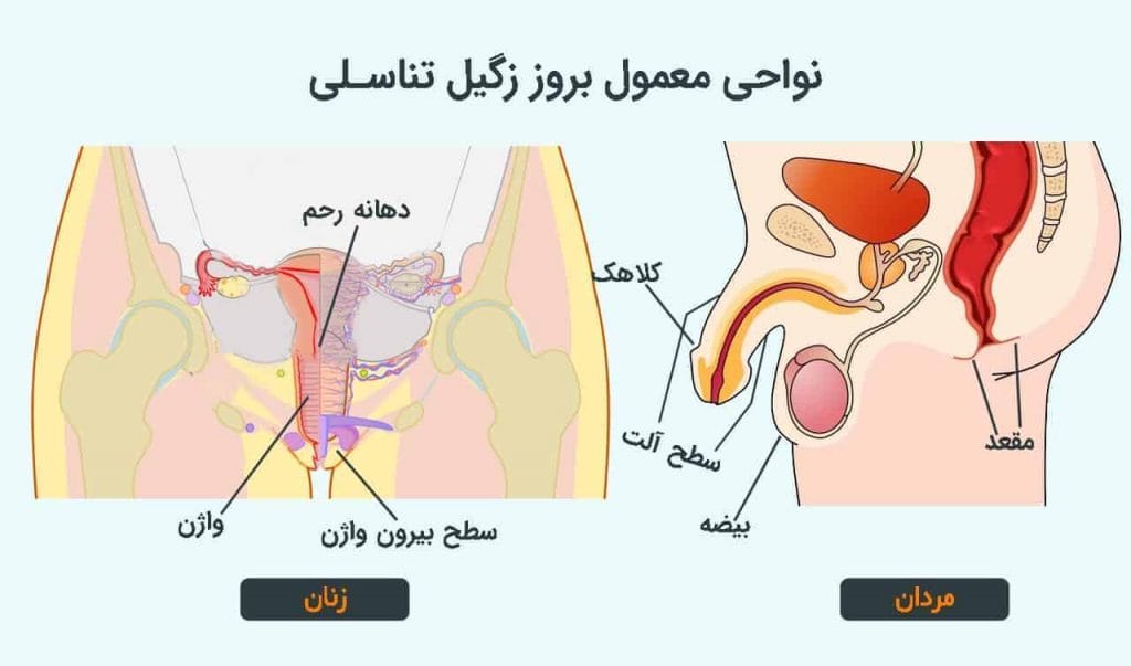 نواحی زگیل تناسلی در زنان و مردان