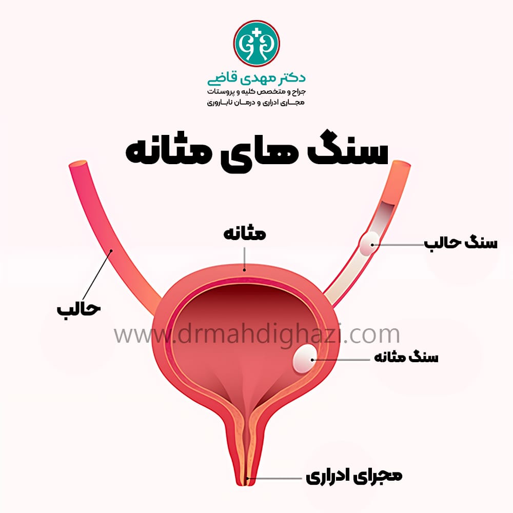 دکتر مهدی قاضی - سنگ مثانه