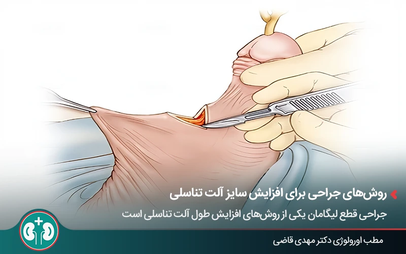 جراحی قطع لیگامان برای افزایش طول آلت تناسلی