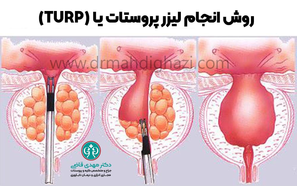 دکتر مهدی قاضی-هایپرپلازی خوش خیم پروستات BPH بزرگ شدن پروستات درمان پروستات علائم پروستات داروهای پروستات جراحی پروستات کاهش علائم پروستات بزرگ شده عوارض‌هایپرپلازی پروستات روش‌های کم تهاجمی درمان BPH ارتباط پروستات با PSA پیشگیری از BPH تشخیص هایپرپلازی پروستات درمان‌های گیاهی BPH نقش ورزش در سلامت پروستات