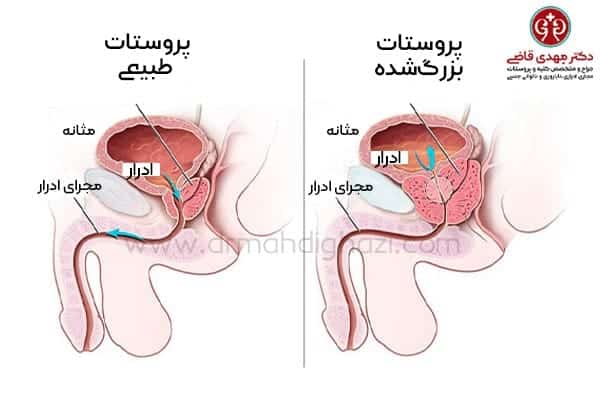 دکتر مهدی قاضی-هایپرپلازی خوش خیم پروستات BPH بزرگ شدن پروستات درمان پروستات علائم پروستات داروهای پروستات جراحی پروستات کاهش علائم پروستات بزرگ شده عوارض‌هایپرپلازی پروستات روش‌های کم تهاجمی درمان BPH ارتباط پروستات با PSA پیشگیری از BPH تشخیص هایپرپلازی پروستات درمان‌های گیاهی BPH نقش ورزش در سلامت پروستات