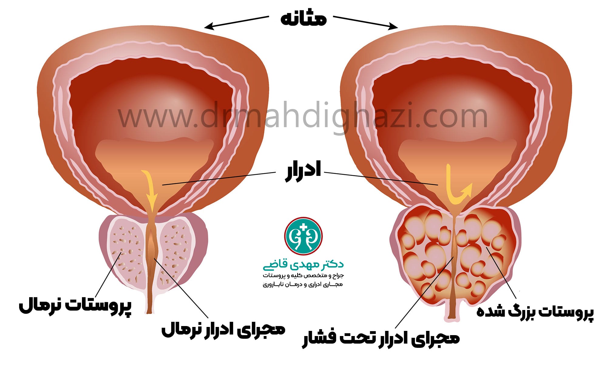 دکتر مهدی قاضی-هایپرپلازی خوش خیم پروستات BPH بزرگ شدن پروستات درمان پروستات علائم پروستات داروهای پروستات جراحی پروستات کاهش علائم پروستات بزرگ شده عوارض‌هایپرپلازی پروستات روش‌های کم تهاجمی درمان BPH ارتباط پروستات با PSA پیشگیری از BPH تشخیص هایپرپلازی پروستات درمان‌های گیاهی BPH نقش ورزش در سلامت پروستات