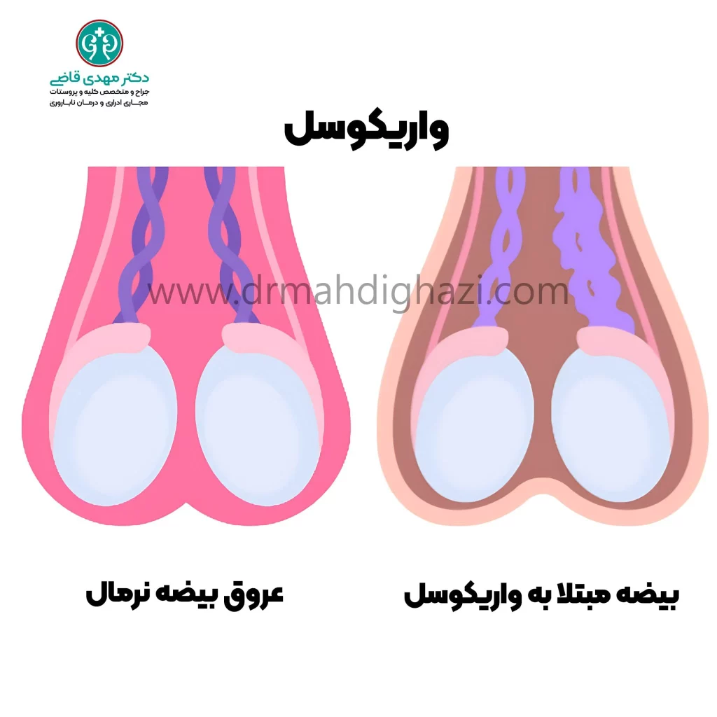 واریکوسل؛ علل، علائم، تأثیرات بر باروری و روش‌های درمان