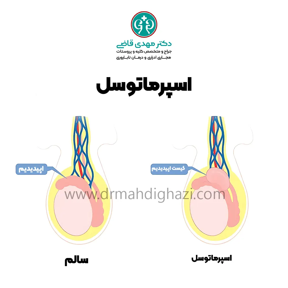 کیست اپیدیدیم