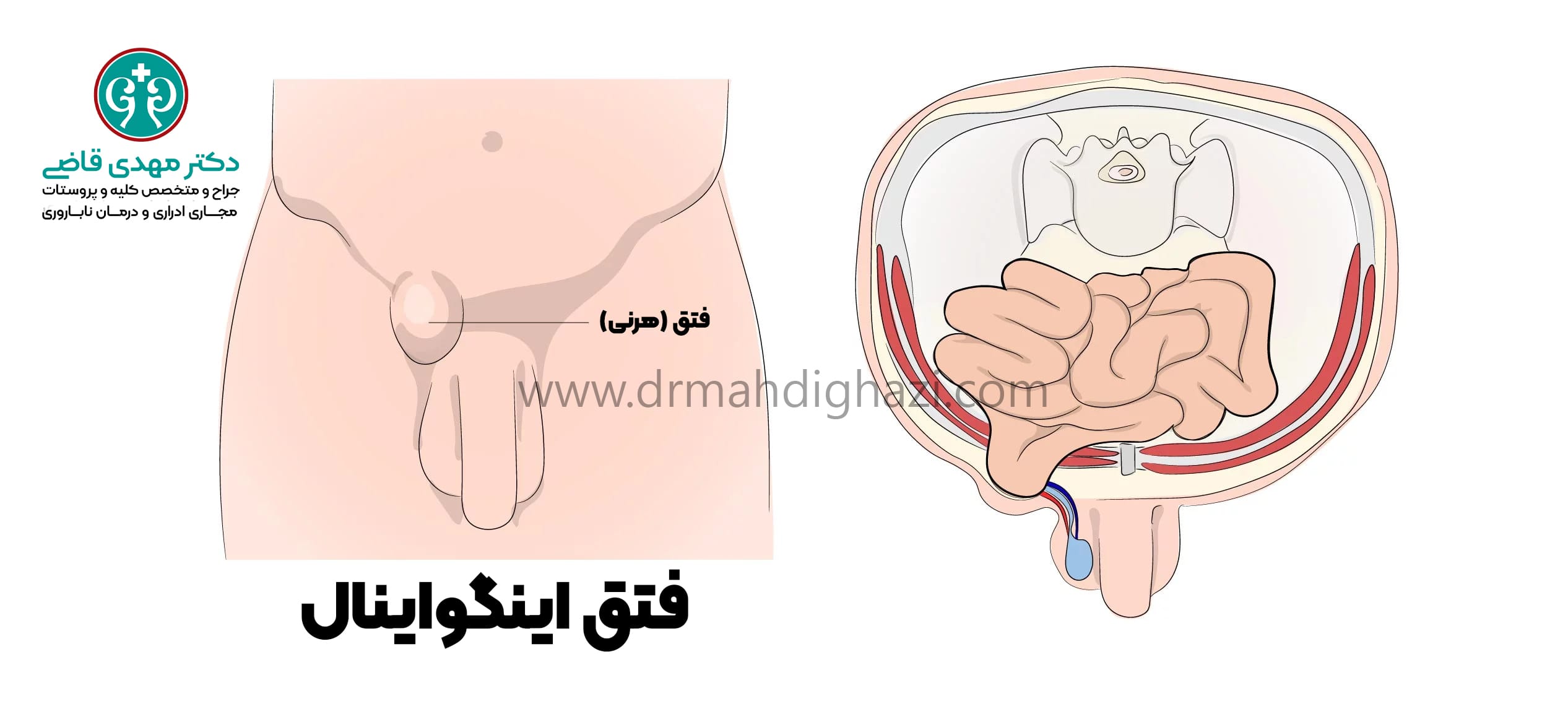 دکتر مهدی قاضی-هرنی اینگوینال