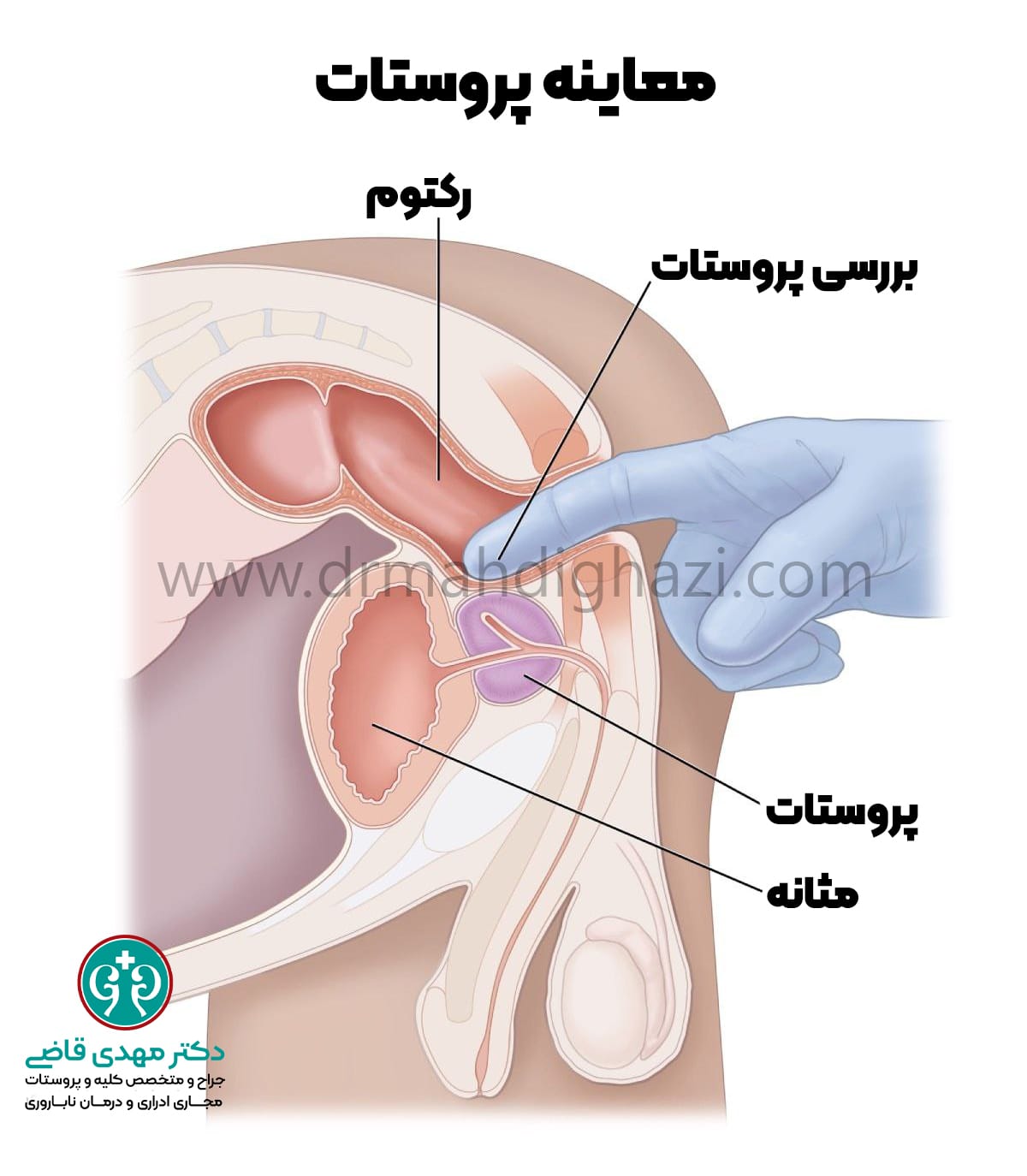 دکتر مهدی قاضی- معاینه پروستات