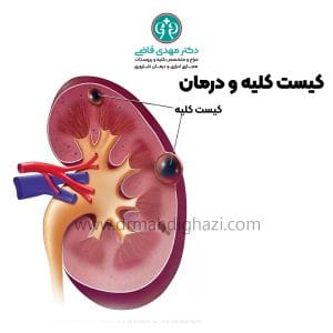 دکتر مهدی قاضی-کیست کلیه: علل، علائم، تشخیص و روش‌های درمان