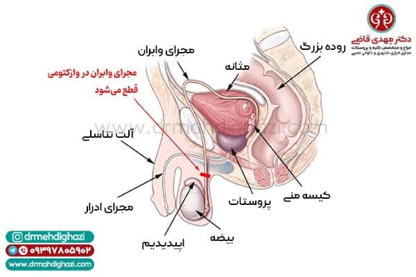 عکس و فیلم بستن لوله مردان