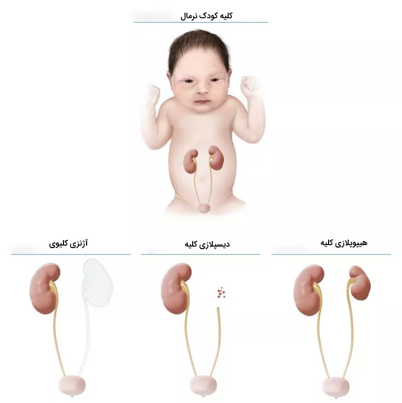 Fetal kidney dysplasia