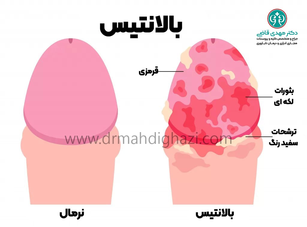 دکتر مهدی قاضی- بالانیت قارچی