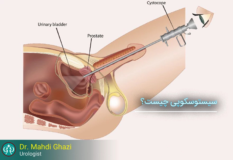 سیستوسکوپی