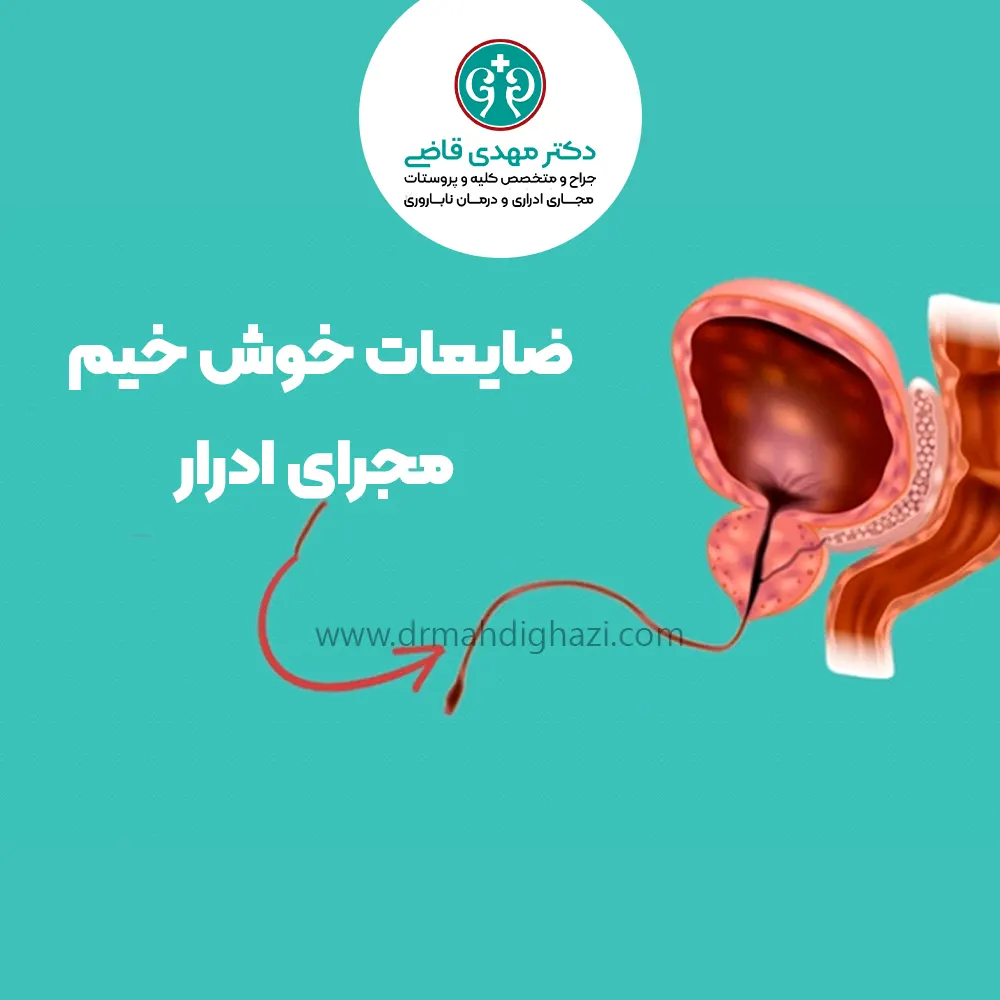 ضایعات خوش خیم مجرای ادرار