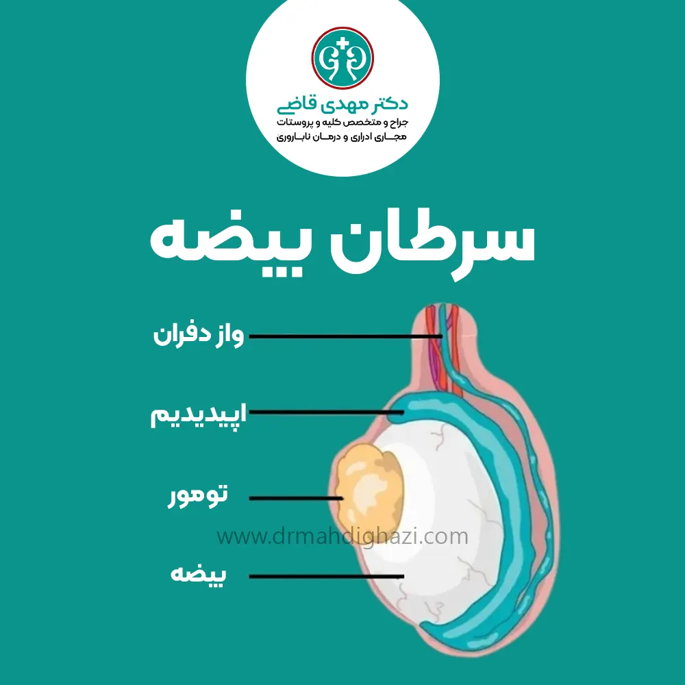 سرطان بیضه