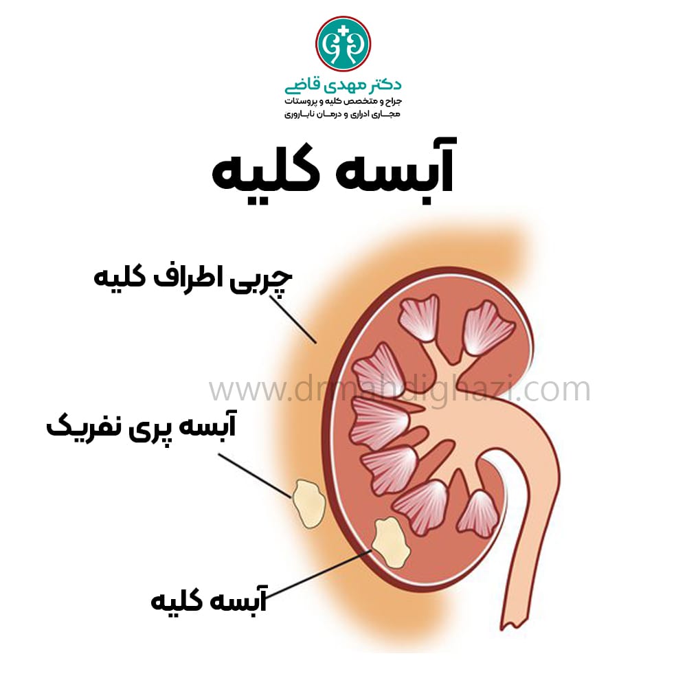 دکتر مهدی قاضی آبسه کلیه درمان و علت