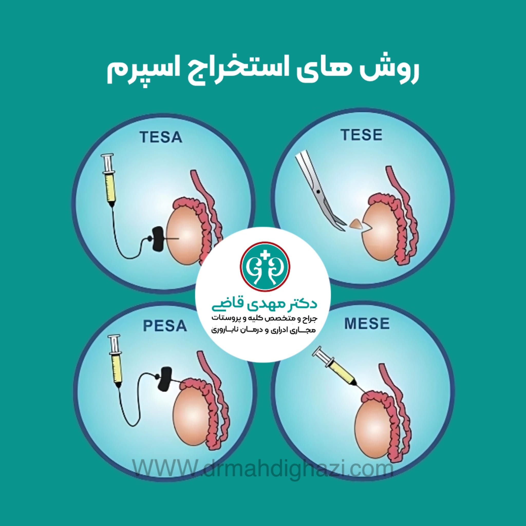 دکتر مهدی قاضی-ناباروری مردان اسپرم صفر اسپرم ضعیف آزمایش اسپرم تحلیل اسپرم علل ناباروری مردان درمان واریکوسل