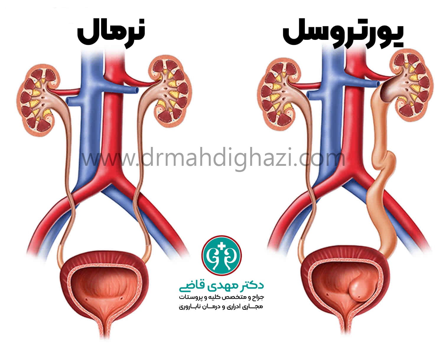 دکتر مهدی قاضی-• یورتروسل • دوپلیکاسیون حالب • عوارض یورتروسل • تشخیص یورتروسل • درمان یورتروسل • علائم یورتروسل در کودکان • جراحی برای درمان یورتروسل • عوارض یورتروسل در زنان • نحوه تشخیص یورتروسل با سونوگرافی • موفقیت جراحی یورتروسل