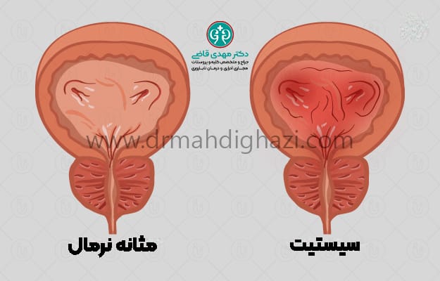 دکتر مهدی قاضی-سیستیت التهاب مثانه درمان التهاب مثانه عفونت مثانه درمان عفونت مثانه علائم التهاب مثانه عفونت مثانه در کودکان التهاب مثانه در زنان درمان سیستیت علائم سیستیت پیشگیری از سیستیت درمان طبیعی سیستیت در خانه علل شایع سیستیت سیستیت در دوران بارداری سیستیت بینابینی علائم و درمان سیستیت مزمن