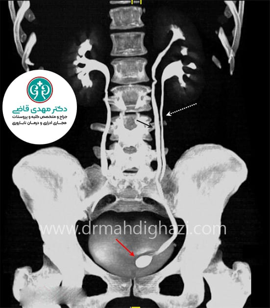 دکتر مهدی قاضی-• یورتروسل • دوپلیکاسیون حالب • عوارض یورتروسل • تشخیص یورتروسل • درمان یورتروسل • علائم یورتروسل در کودکان • جراحی برای درمان یورتروسل • عوارض یورتروسل در زنان • نحوه تشخیص یورتروسل با سونوگرافی • موفقیت جراحی یورتروسل