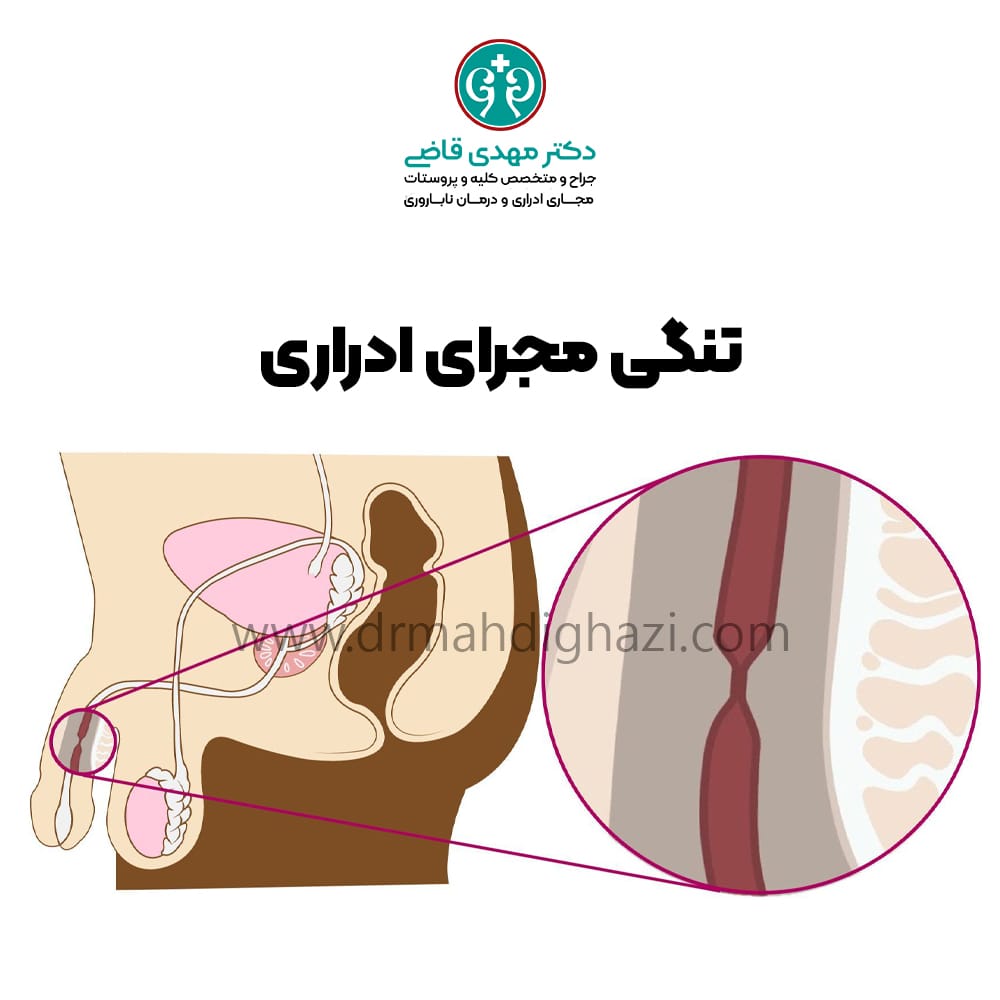 دکتر مهدی قاضی-تنگی مجرای ادرار علائم درمان