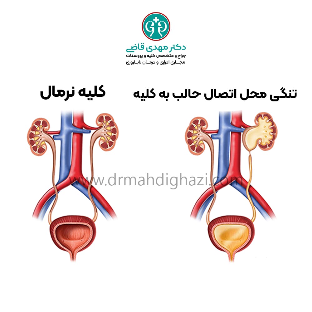 دکتر مهدی قاضی- تنگی مجرای ادرار