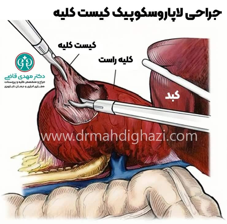 دکتر مهدی قاضی-کیست کلیه کیست‌های کلیوی کلیه پلی کیستیک کیست ساده کلیه علائم کیست کلیه درمان کیست کلیه علت ایجاد کیست کلیه در بزرگسالان درمان درد کیست کلیه علائم کیست عفونی کلیه آیا کیست‌های کلیه می‌توانند سرطانی شوند دوره بهبودی پس از جراحی برداشتن کیست کلیه درمان خانگی کیست کلیه کیست‌های کلیوی در بزرگسالان علائم عفونت کیست کلیه دوره بهبودی پس از جراحی کیست کلیه آیا کیست‌های کلیه می‌توانند سرطانی شوند؟ 