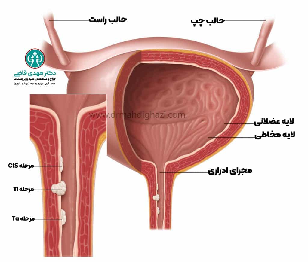 دکتر مهدی قاضی- درجه بندی و مرحله بندی سرطان پیشابراه