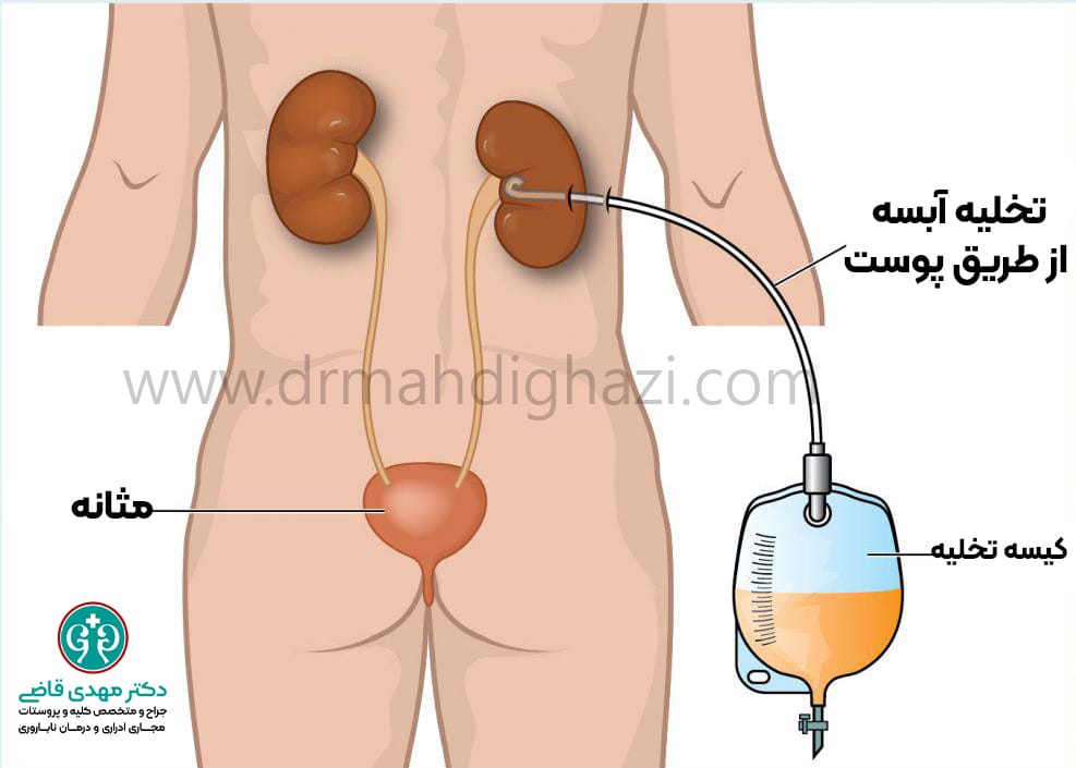 دکتر مهدی قاضی علل و درمان آبسه کلیوی