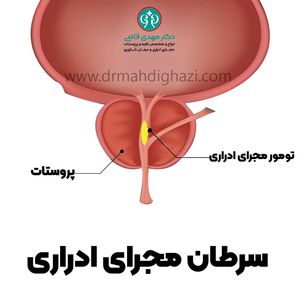 دکتر مهدی قاضی- سرطان مجرای ادراری