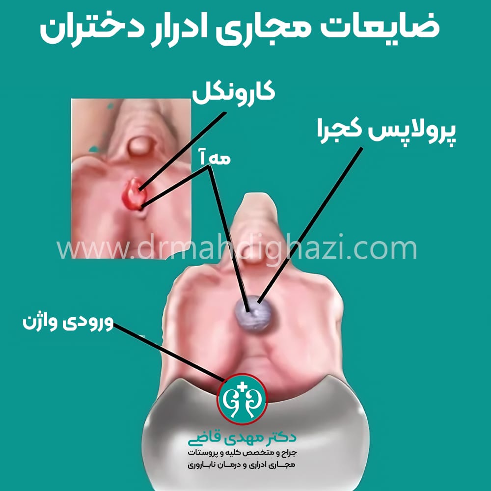 دکتر مهدی قاضی - • پیشگیری از عوارض توده‌های خوش خیم مجرای ادرار در دختران