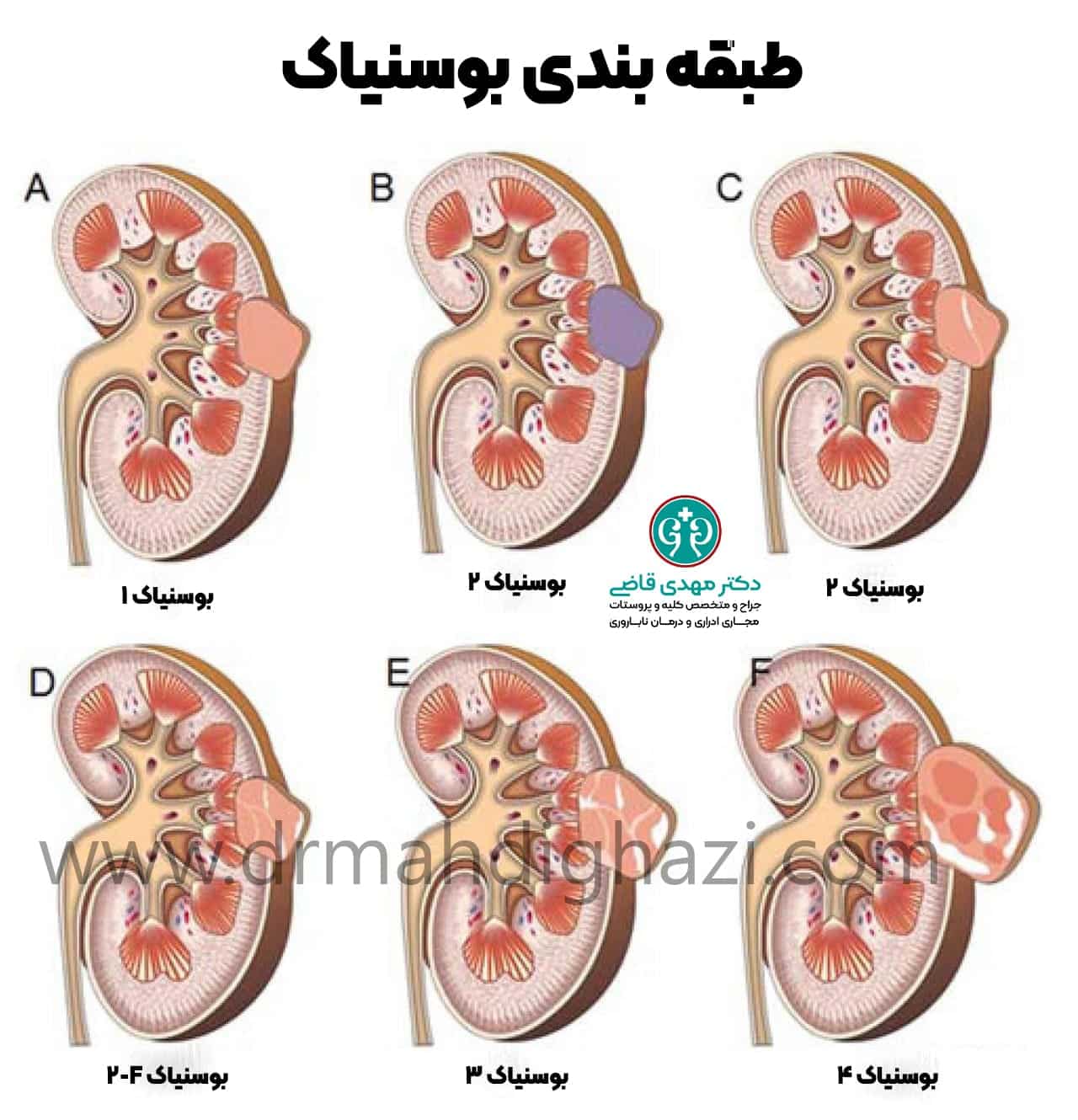 دکتر مهدی قاضی-کیست کلیه کیست‌های کلیوی کلیه پلی کیستیک کیست ساده کلیه علائم کیست کلیه درمان کیست کلیه علت ایجاد کیست کلیه در بزرگسالان درمان درد کیست کلیه علائم کیست عفونی کلیه آیا کیست‌های کلیه می‌توانند سرطانی شوند دوره بهبودی پس از جراحی برداشتن کیست کلیه درمان خانگی کیست کلیه کیست‌های کلیوی در بزرگسالان علائم عفونت کیست کلیه دوره بهبودی پس از جراحی کیست کلیه آیا کیست‌های کلیه می‌توانند سرطانی شوند؟ 