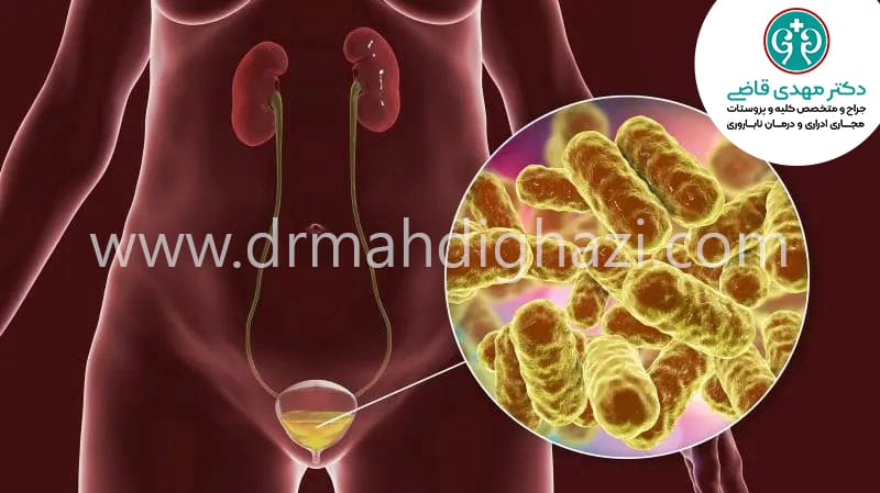 دکتر مهدی قاضی-سیستیت التهاب مثانه درمان التهاب مثانه عفونت مثانه درمان عفونت مثانه علائم التهاب مثانه عفونت مثانه در کودکان التهاب مثانه در زنان درمان سیستیت علائم سیستیت پیشگیری از سیستیت درمان طبیعی سیستیت در خانه علل شایع سیستیت سیستیت در دوران بارداری سیستیت بینابینی علائم و درمان سیستیت مزمن