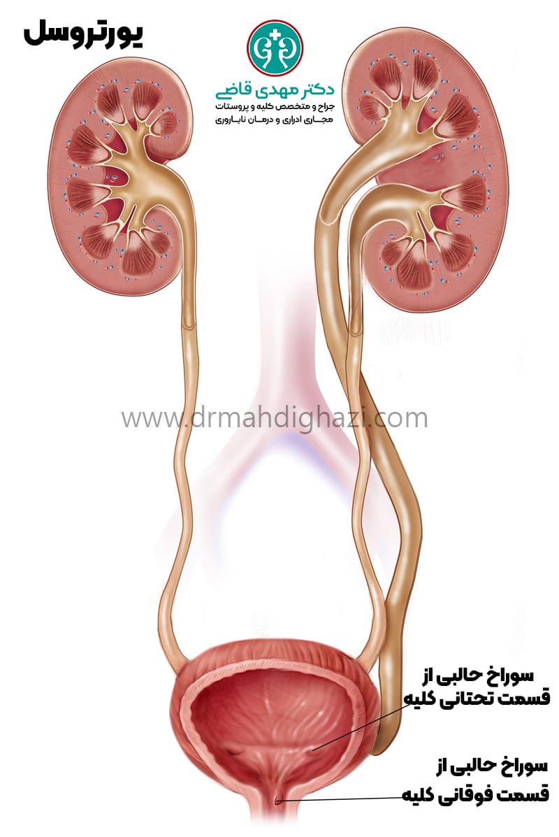 دکتر مهدی قاضی-• یورتروسل • دوپلیکاسیون حالب • عوارض یورتروسل • تشخیص یورتروسل • درمان یورتروسل • علائم یورتروسل در کودکان • جراحی برای درمان یورتروسل • عوارض یورتروسل در زنان • نحوه تشخیص یورتروسل با سونوگرافی • موفقیت جراحی یورتروسل