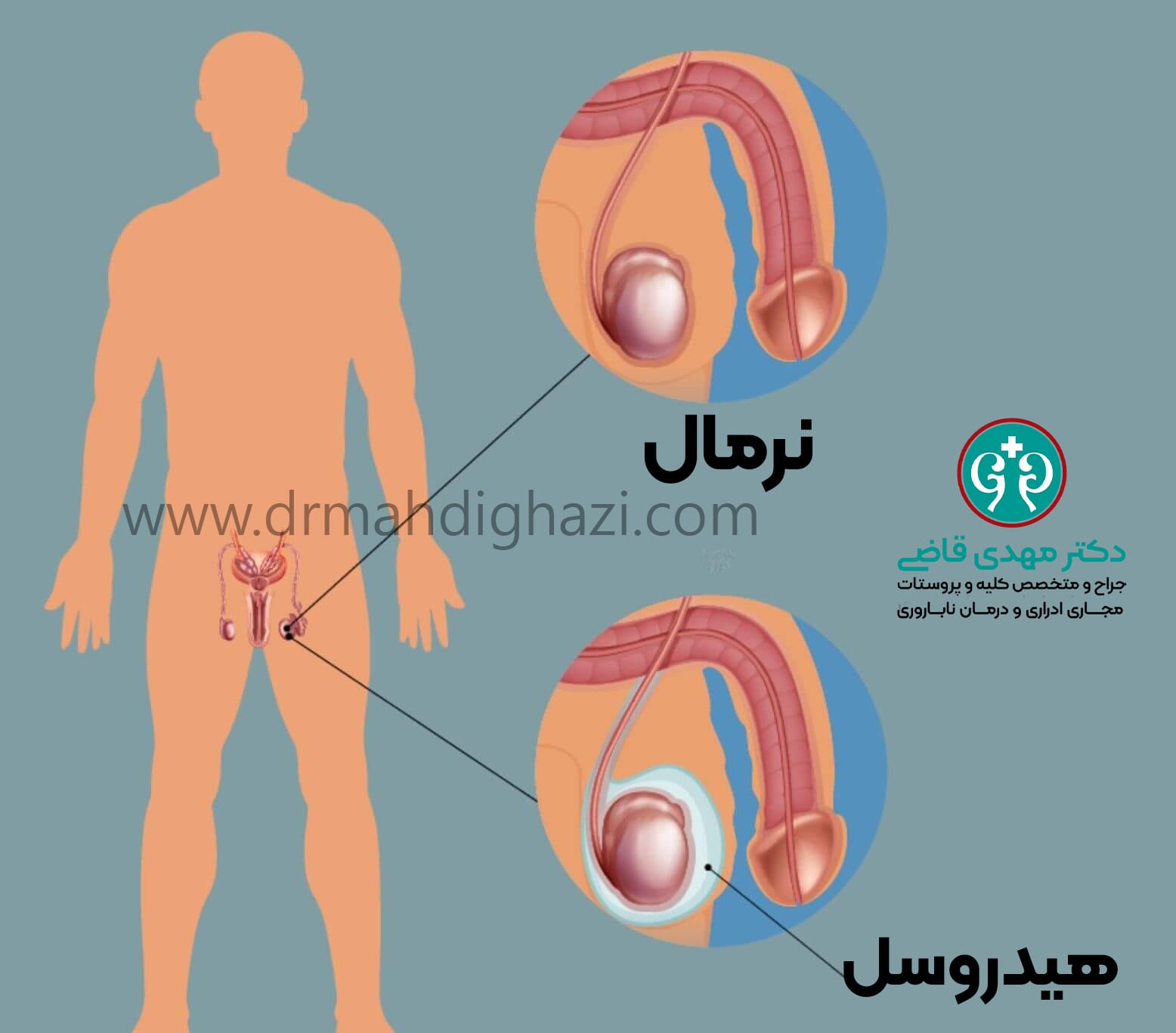 دکتر مهدی قاضی- هیدروسل چیست
درمان هیدروسل
علائم هیدروسل
جراحی هیدروسل
هیدروسل
هیدروسل در کودکان
هیدروسل در نوزادان
تشخیص هیدروسل
هیدروسل ارتباطی
هیدروسل غیر ارتباطی
عوارض هیدروسل
پیشگیری از هیدروسل
بهترین روش‌های درمان هیدروسل
هیدروسل و تأثیر آن بر باروری
تشخیص هیدروسل با سونوگرافی
درمان‌های طبیعی برای هیدروسل
علت‌های مختلف هیدروسل در مردان
