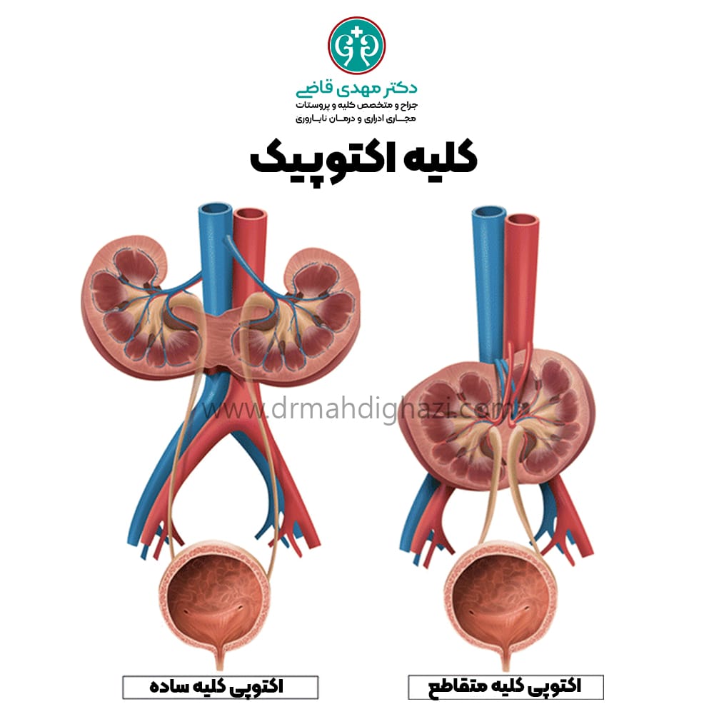 دکتر مهدی قاضی-کلیه اکتوپیک