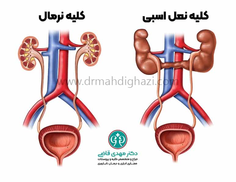 دکتر مهدی قاضی-کلیه نعل اسبی • علت کلیه نعل اسبی • علائم کلیه نعل اسبی • درمان کلیه نعل اسبی • بیماری مادرزادی کلیه نعل اسبی • تشخیص کلیه نعل اسبی در کودکان • کلیه نعل اسبی و عوارض آن • ارتباط کلیه نعل اسبی با سنگ کلیه • نحوه مدیریت کلیه نعل اسبی • خطرات کلیه نعل اسبی در بزرگسالان 