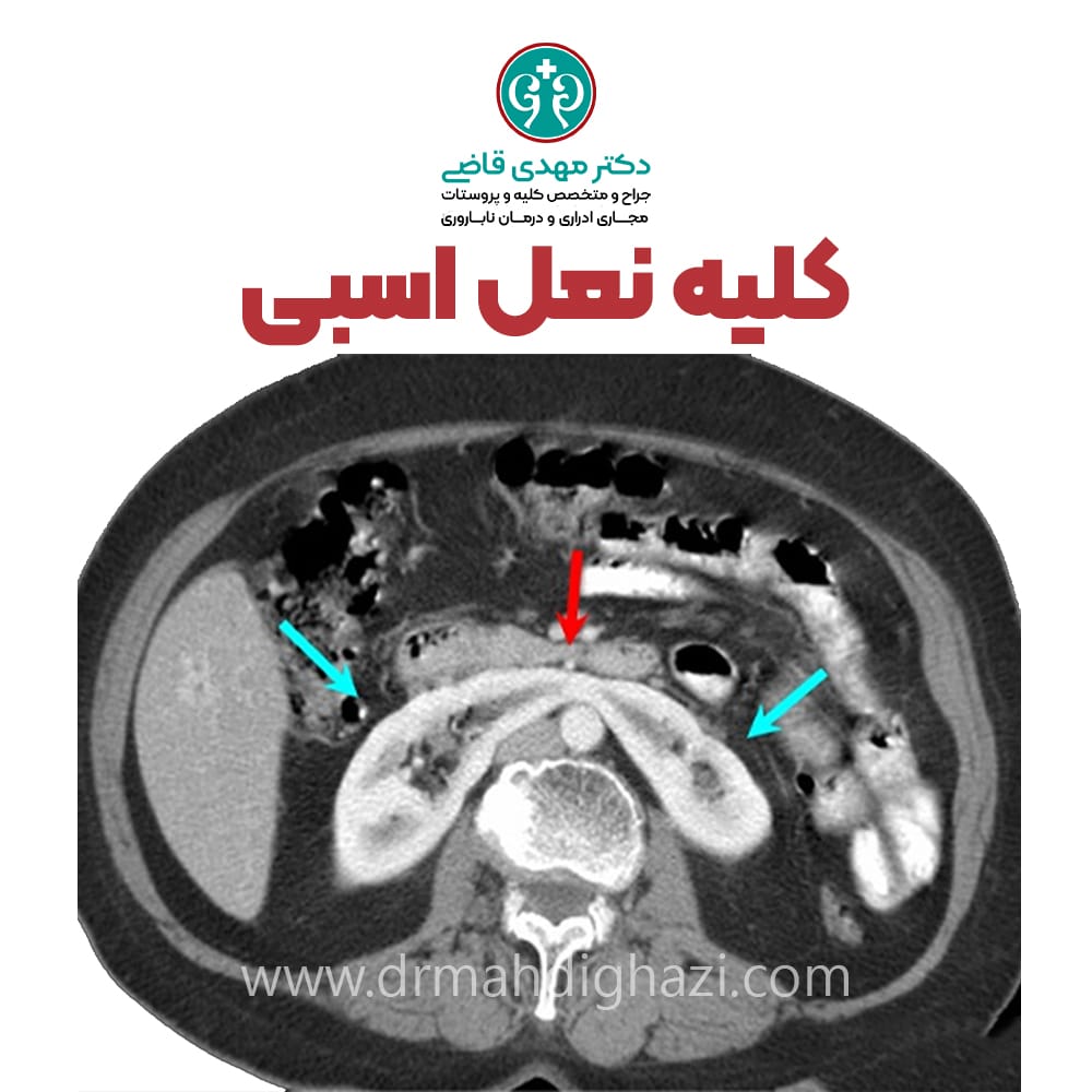 دکتر مهدی قاضی-کلیه نعل اسبی