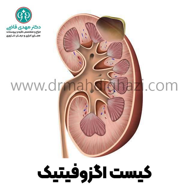 دکتر مهدی قاضی-کیست کلیه کیست‌های کلیوی کلیه پلی کیستیک کیست ساده کلیه علائم کیست کلیه درمان کیست کلیه علت ایجاد کیست کلیه در بزرگسالان درمان درد کیست کلیه علائم کیست عفونی کلیه آیا کیست‌های کلیه می‌توانند سرطانی شوند دوره بهبودی پس از جراحی برداشتن کیست کلیه درمان خانگی کیست کلیه کیست‌های کلیوی در بزرگسالان علائم عفونت کیست کلیه دوره بهبودی پس از جراحی کیست کلیه آیا کیست‌های کلیه می‌توانند سرطانی شوند؟ 