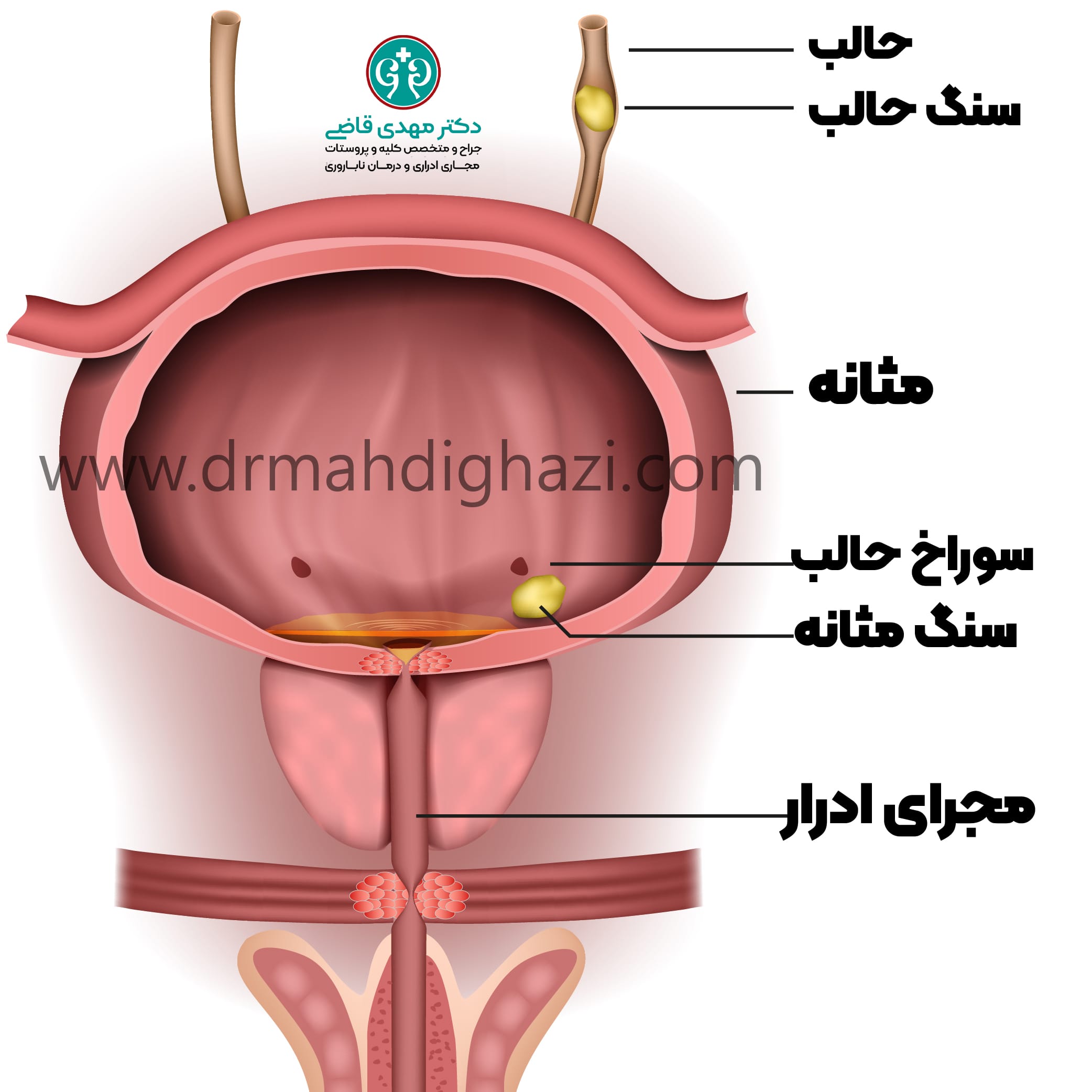 دکتر مهدی قاضی- نحوه تشخیص سنگ مثانه