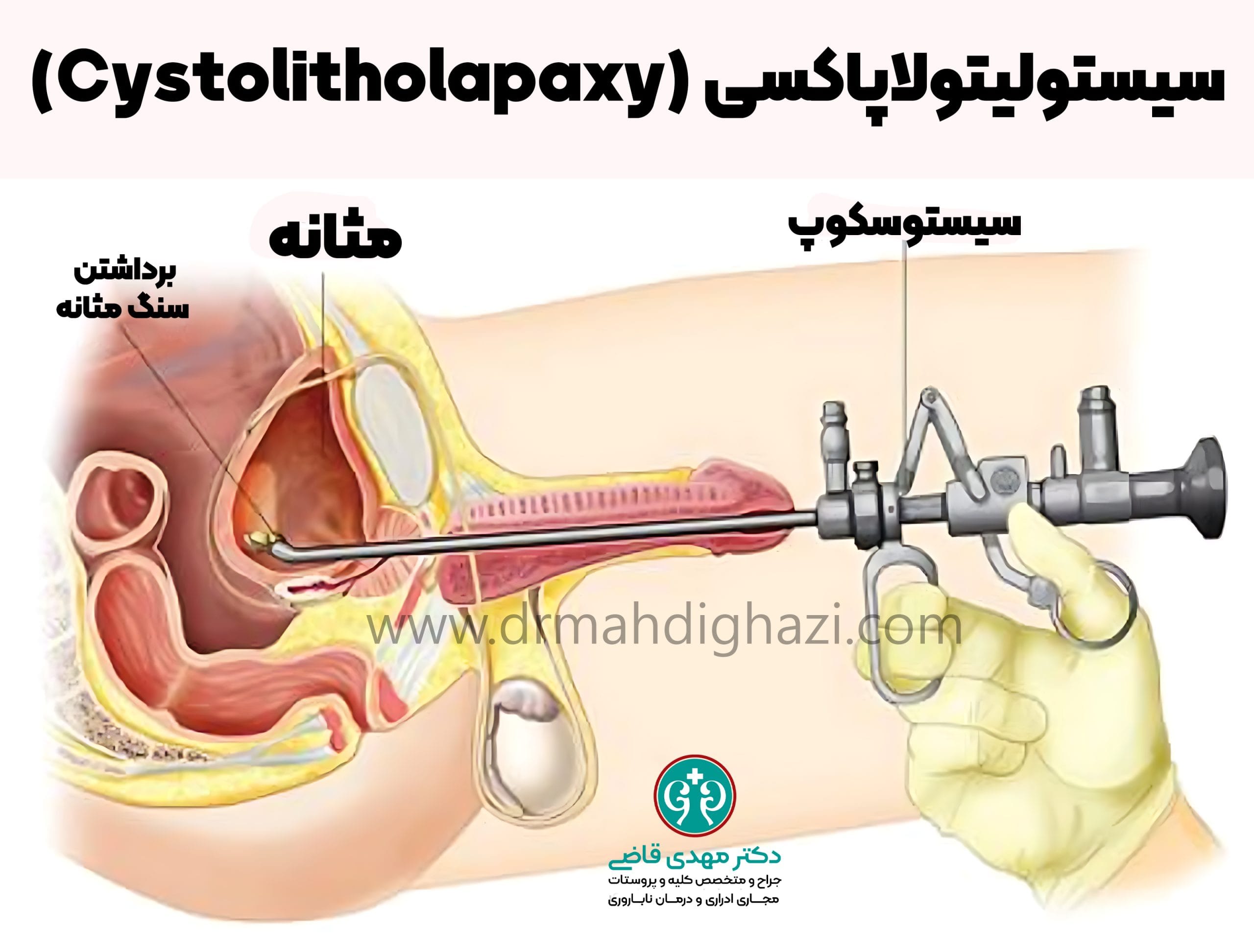 دکتر مهدی قاضی - درمان سنگ مثانه